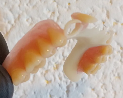 Reparación de una prótesis dental parcial en el laboratorio