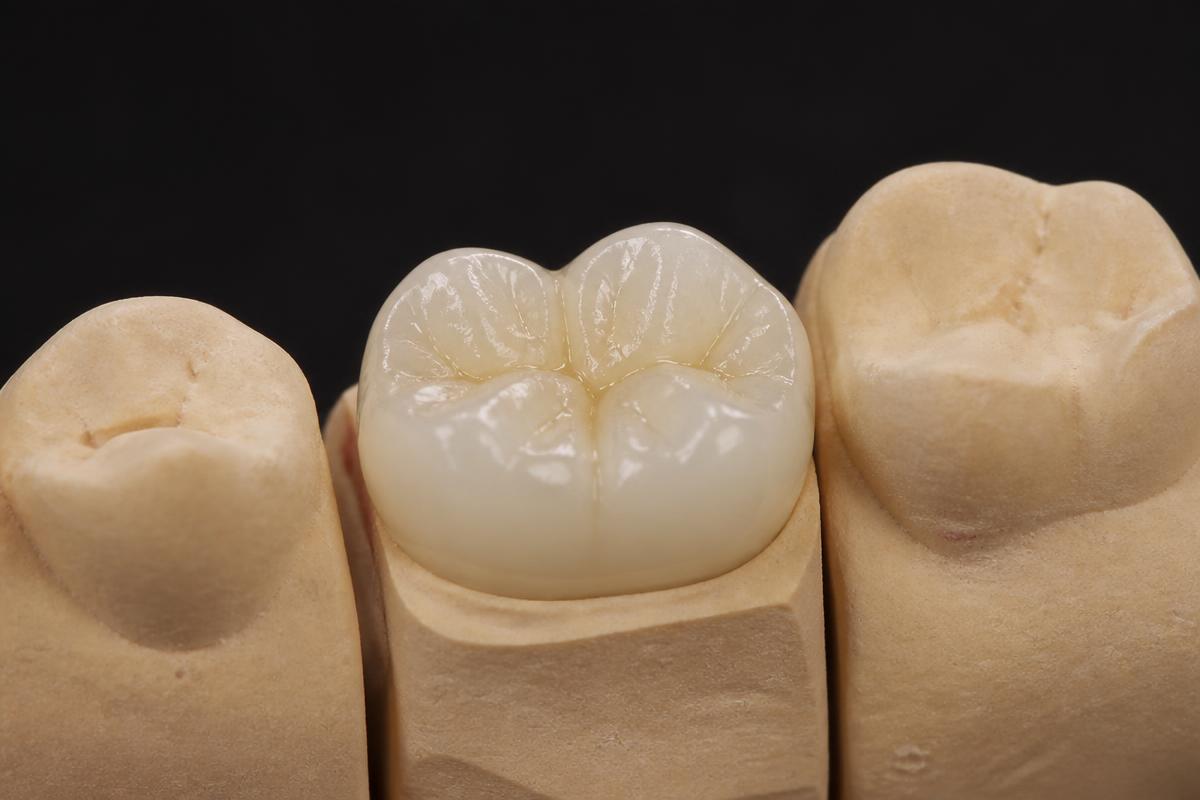 Corona dental de zirconio sobre modelo de yeso